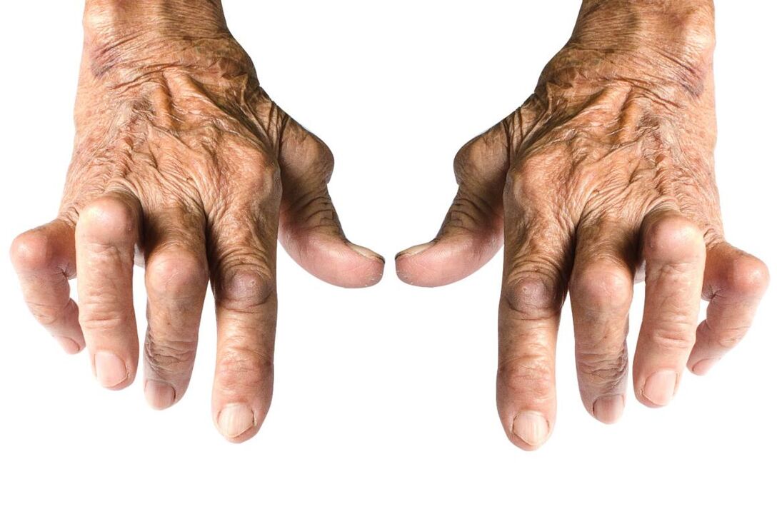 Anzeichen von Arthritis - Gelenkdeformität