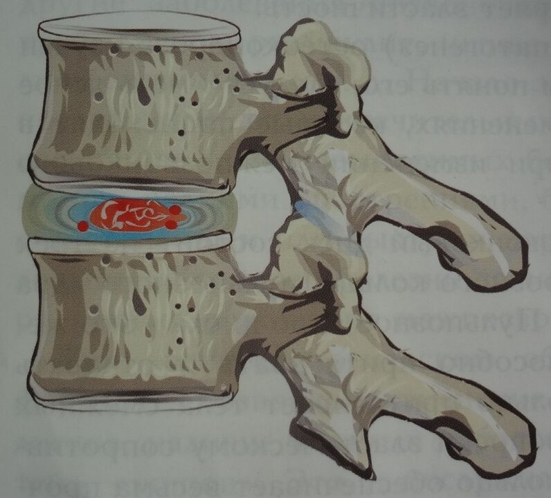 Schädigung des Nucleus pulposus der Bandscheibe im ersten Stadium der zervikalen Osteochondrose. 