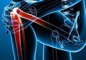 Knieschmerzen bei Arthritis und Arthrose