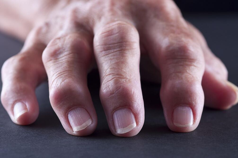 Eine Schleimbeutelentzündung ist durch Schmerzen, Entzündungen und Schwellungen der Fingergelenke gekennzeichnet. 