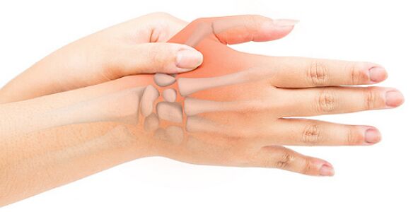 Eine stenosierende Ligamentitis blockiert den Finger in einer gebeugten Position. 