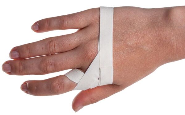 Fixierung eines Fingers bei posttraumatischer Osteomyelitis. 