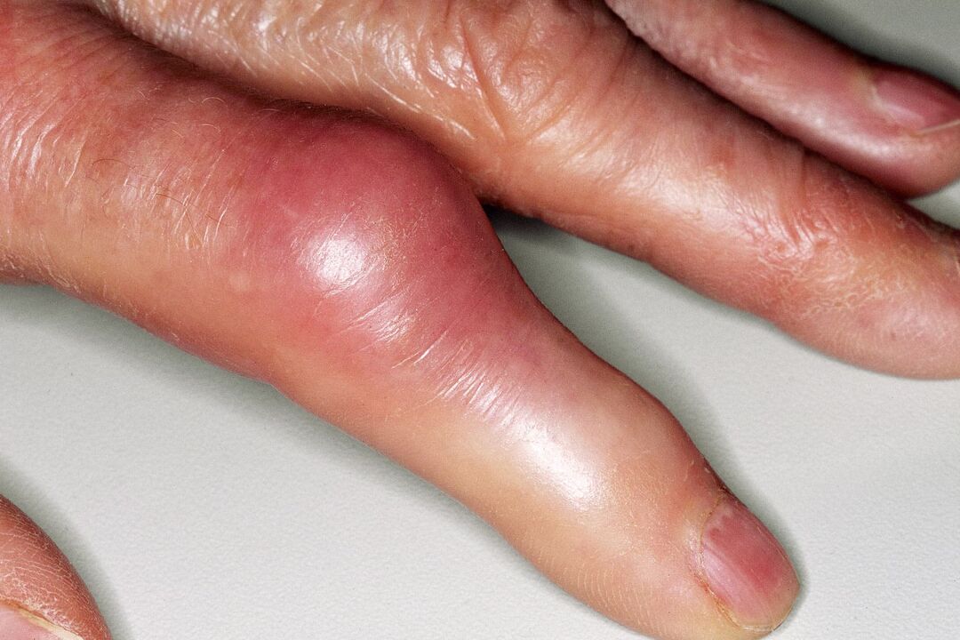 Schwellung, Verformung des Fingergelenks und akute Schmerzen nach einer Verletzung. 