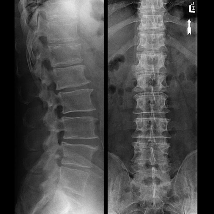 Säule mit Osteochondrose durchführen