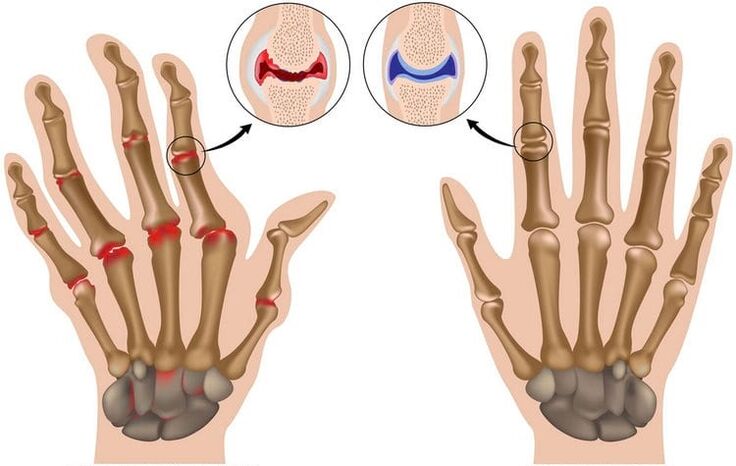 Gesunde Handgelenke und durch Arthrose geschädigte Gelenke.
