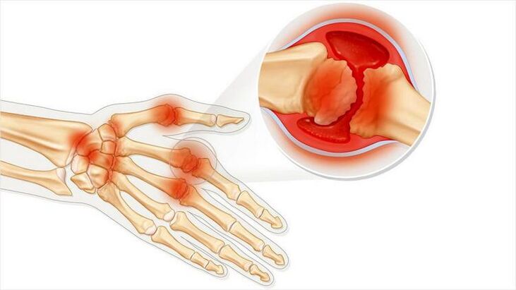 Schädigung der Handgelenke durch Arthritis.