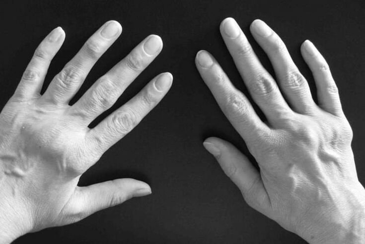 Symptome einer Arthritis in den Gelenken der Hände.