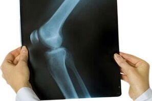 Arthrose des Kniegelenks im Röntgenbild
