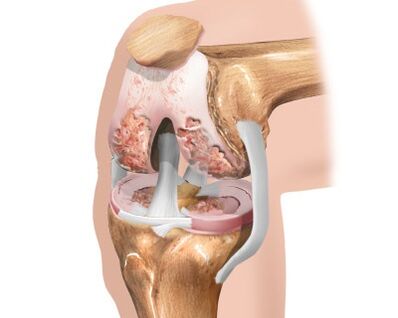Zerstörung des Kniegelenks durch Arthrose.