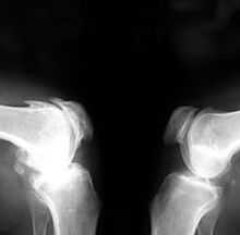 Arthrose im Röntgenbild